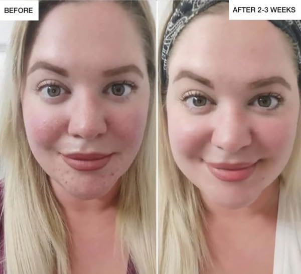 reVive Light Therapy Clinical XL for Acne, Blue LED Light Therapy Device for Skincare & Acne, Portable & Rechargeable At-Home LED System, Skincare Tools for Men & Women