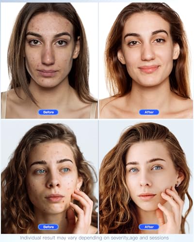 NEWKEY LED Face Mask Light Therapy,Red Light Therapy for Face Wrinkle Blue Light Therapy Mask for Face Acne,150LEDs,10 Min Auto Shut off, Wired