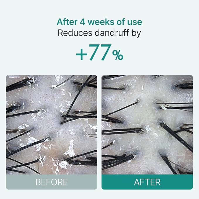 lilyeve SCALPTURN Cica PDRN Scalp Serum with Built-in Brush, PDRN to Strengthen Hair Roots, Itchy Scalp Relief, Dry Scalp Hydration - Korean Hair Care, 3.38 fl.oz