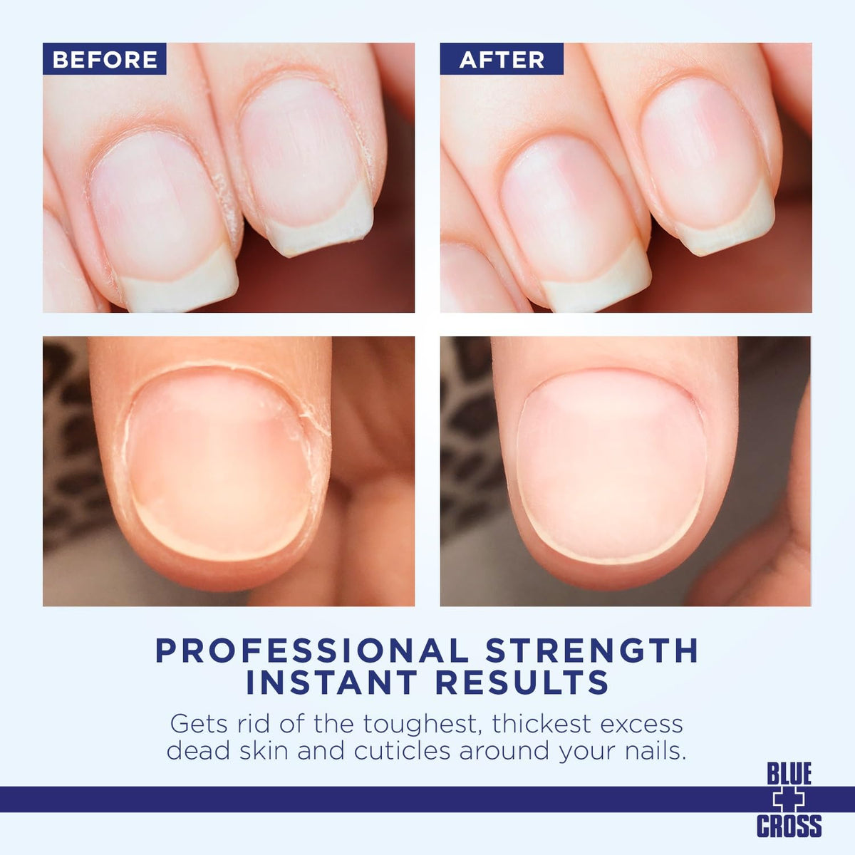 Blue Cross Cuticle Remover Liquid, Cuticle Softener for Nails, Profess ...