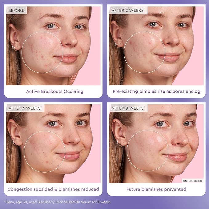 Glow Recipe Gentle Blackberry Retinol Serum, Korean Retinol Night Serum for Sensitive Skin, Triple Retinoids + Glycerin, Clarifying for Blemishes, Smooths Texture and Fine Lines (30ml)